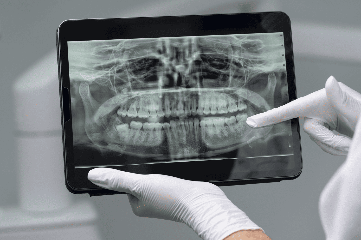 Full Mouth X-Ray