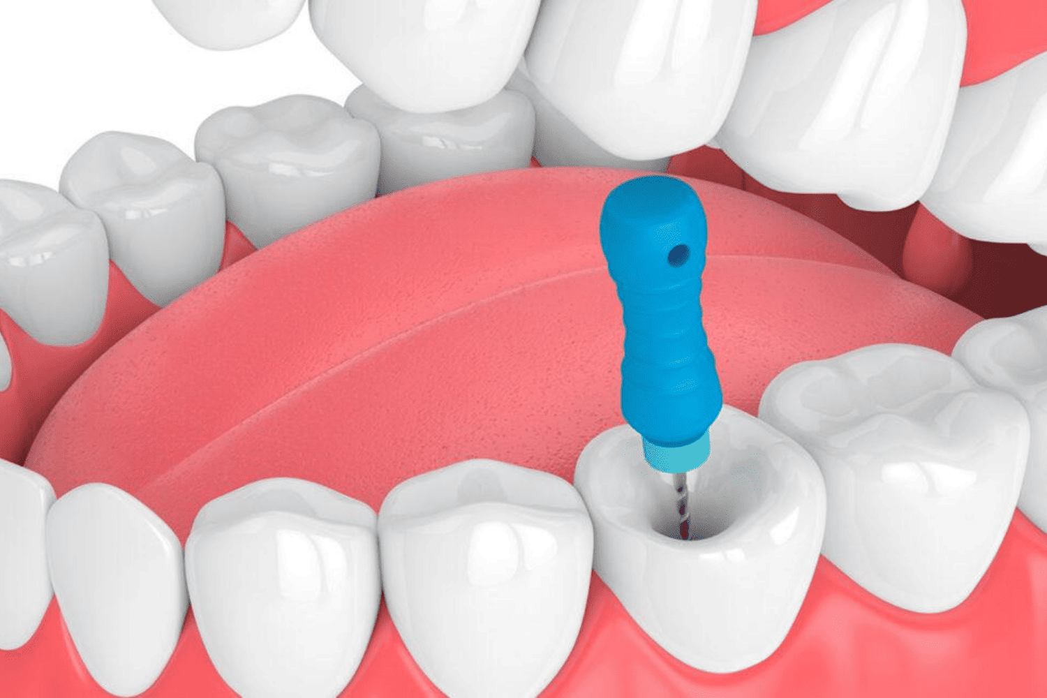 Single Sitting Root Canal
