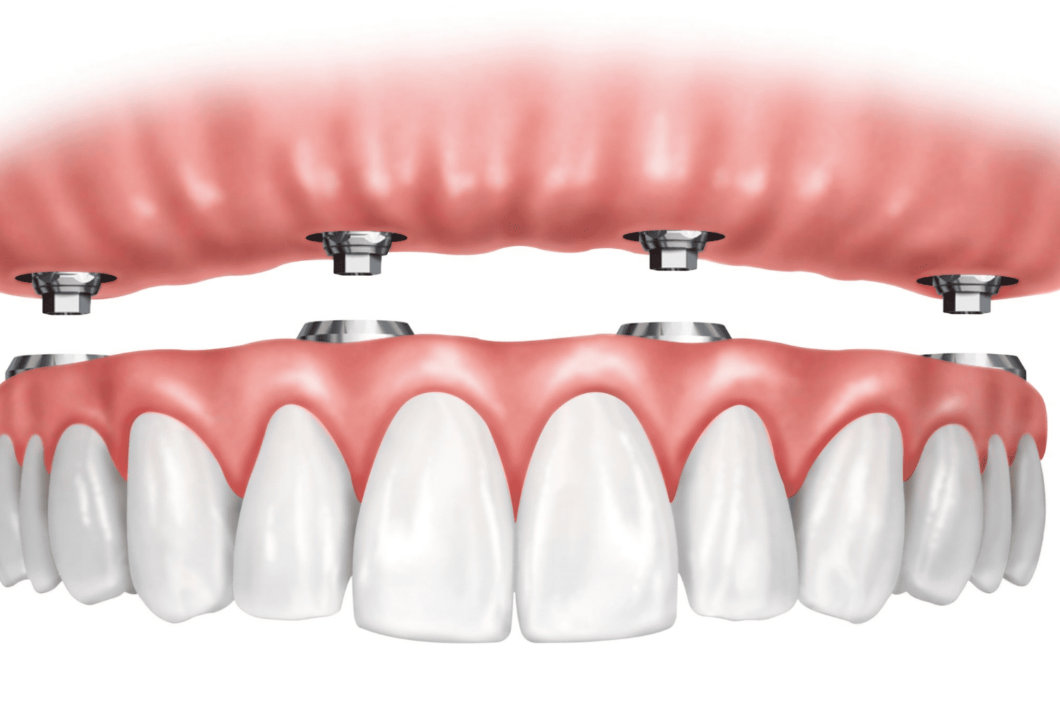 Hybrid Dentures