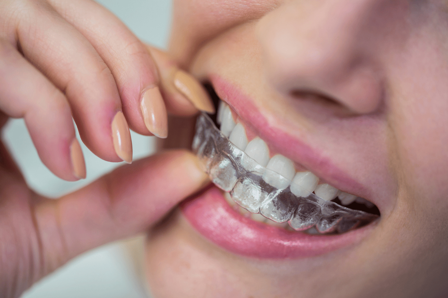 Invisible Braces & Tooth Aligners in Jaipur