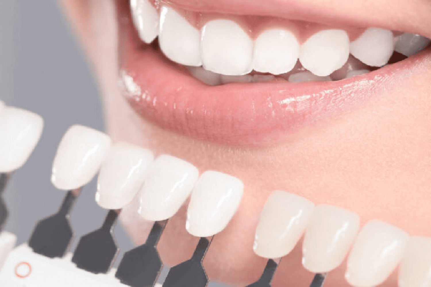 Veneers