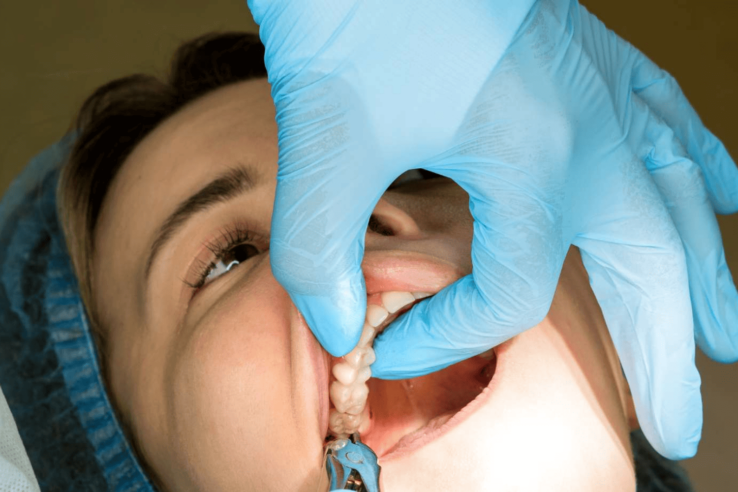 Wisdom Tooth Extraction in Jaipur